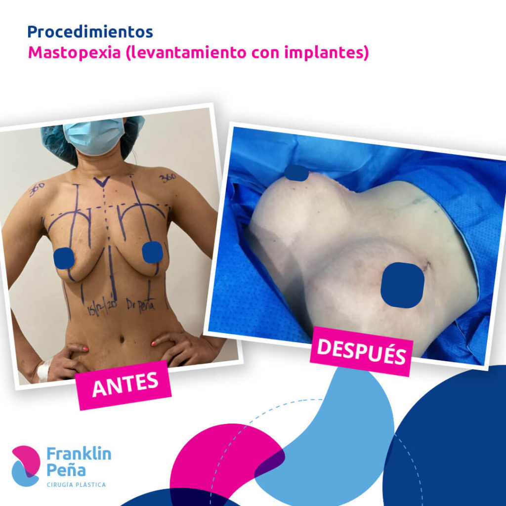 Levantamiento de senos sin implantes ▻ Dr. Guevara