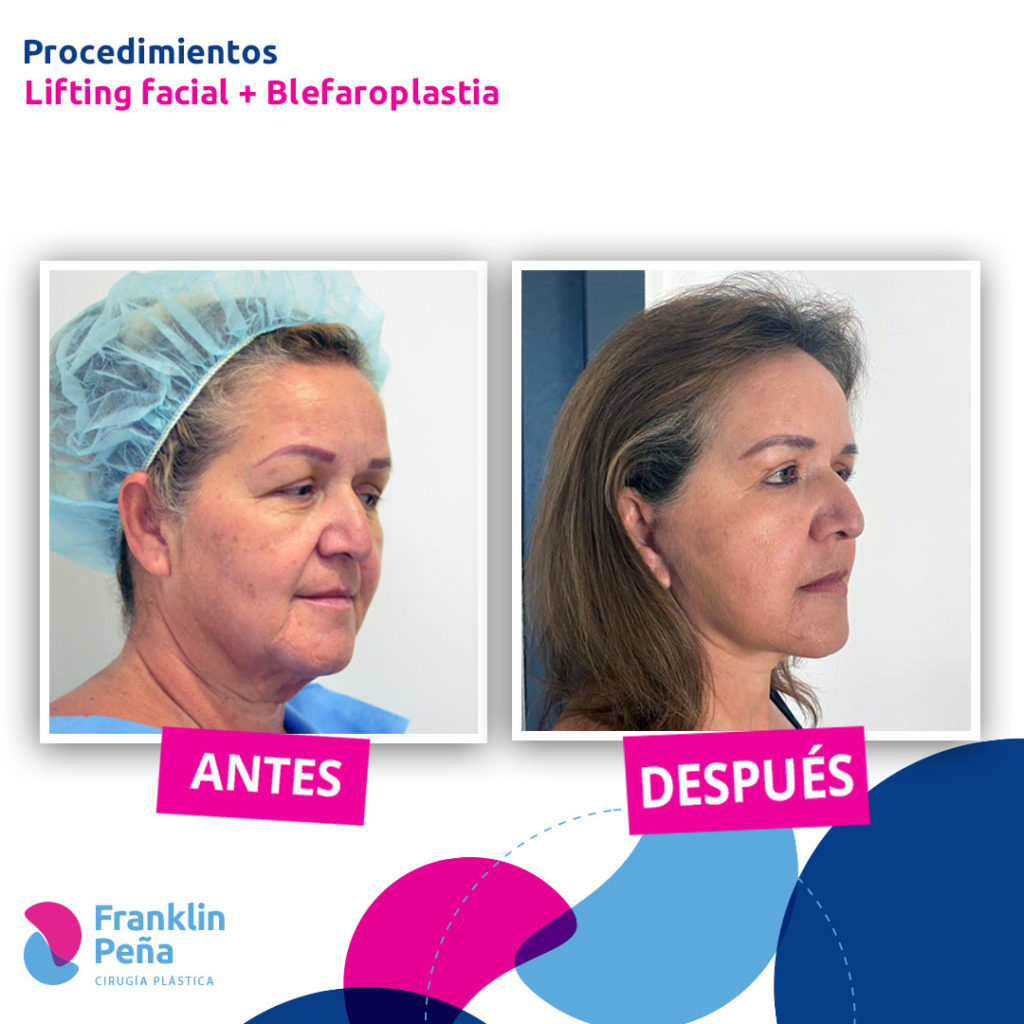 Antes y Después - Dr. Franklin Peña