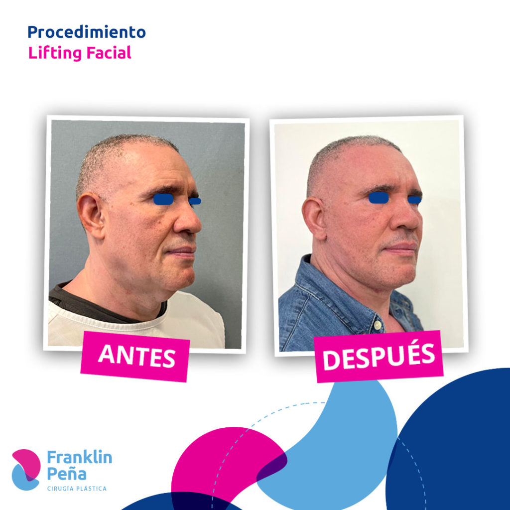 Antes y Después - Dr. Franklin Peña